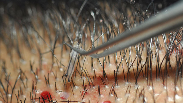 implants capillaires