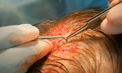 microgreffe de cheveux