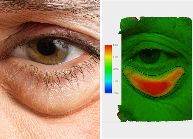 poches sous les yeux