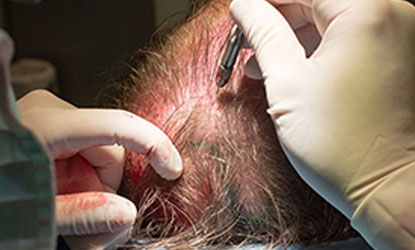 ultra microgreffe de cheveux
