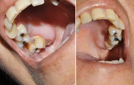 Sclérodermie systémique et chirurgie orale