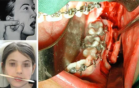 Chirurgie orthognathique et SADAM - Lien ou coïncidence ?