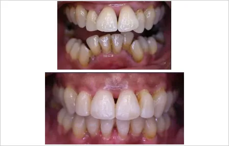 Gouttières chirurgico-orthodontiques - Intérêts pour le chirurgien et l'orthodontiste