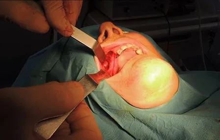 Greffe osseuse implants dentaires matrice plasmatique mineralisee