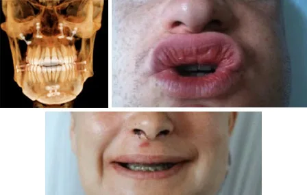 Intérêt de la rééducation précoce - en chirurgie orthognatique