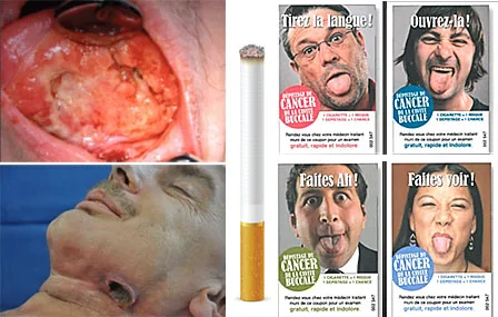 Lesions precancereuses cancereuses cavite buccale