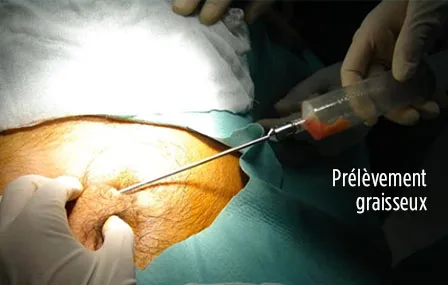 Lipofilling chirurgie maxillo faciale