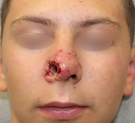Lambeau frontal